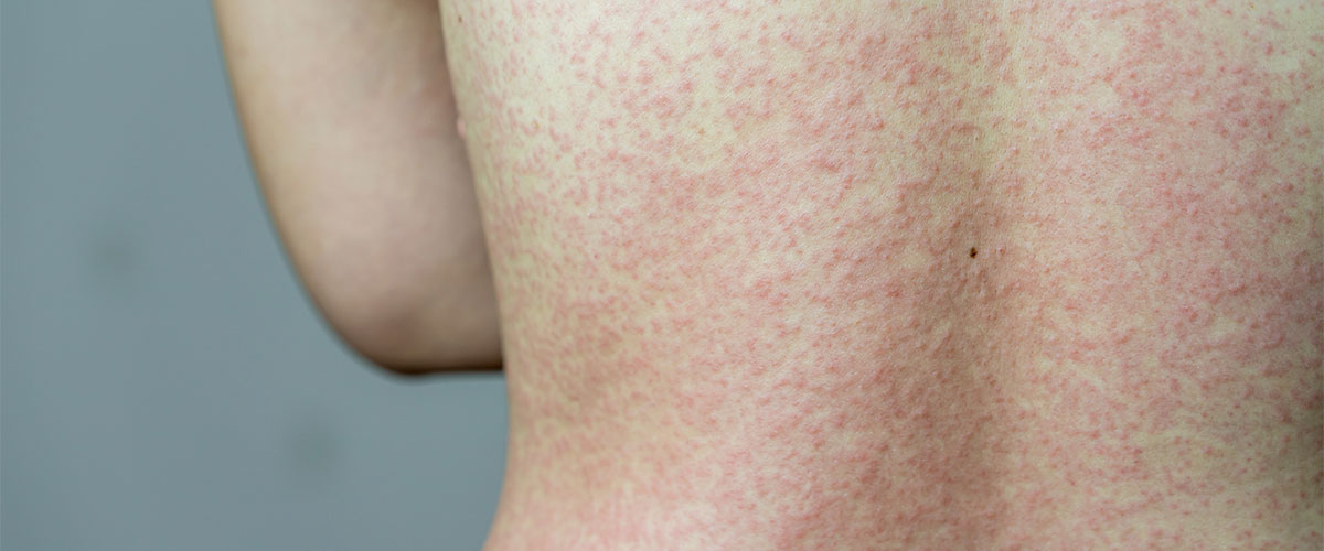 Sarampión: una enfermedad erradicada en Chile que sigue siendo riesgosa por brotes en países vecinos